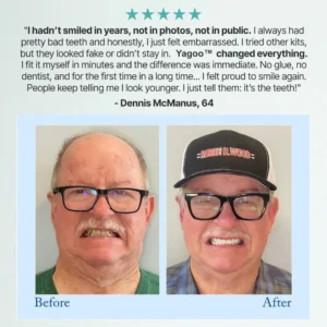 Yagoo® 🦷Advanced Customized Full Denture Set🦷 (🔥10,000+ Sold In Last 30 Day)