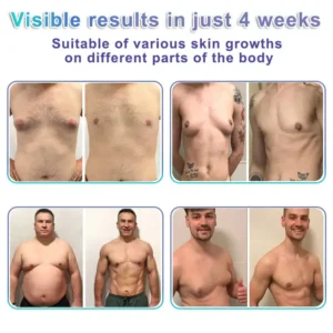 GFOUK® NanoMedix Gynecomastia Chest Fatburn & Firm Patch