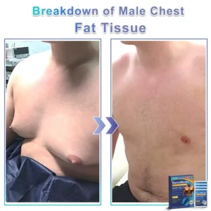 GFOUK® NanoMedix Gynecomastia Chest Fatburn & Firm Patch