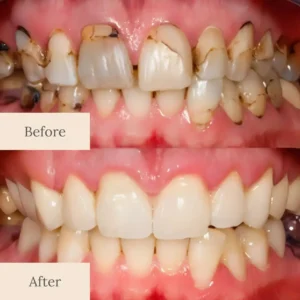 LOVILDS™ Teeth Armor Drops