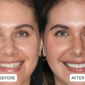 LOVILDS™ Teeth Armor Drops