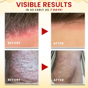 RZXEA™ Bee Venom Psoriasis Treatment Cream