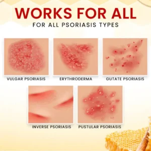 RZXEA™ Bee Venom Psoriasis Treatment Cream