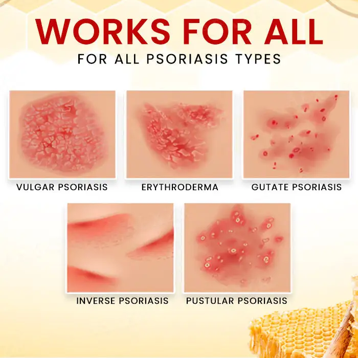 RZXEA™ Bee Venom Psoriasis Treatment Cream