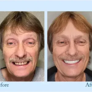 Hidone™ – Premium-Zahnprothese