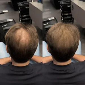 2026🎁LAST DAY 60％ OFF -YAGOO Haarverdichtungs-Puder