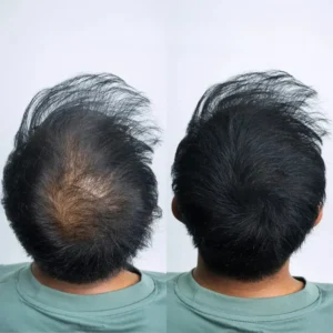 2026🎁LAST DAY 60％ OFF -YAGOO Haarverdichtungs-Puder