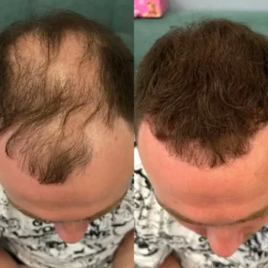 2026🎁LAST DAY 60％ OFF -YAGOO Haarverdichtungs-Puder