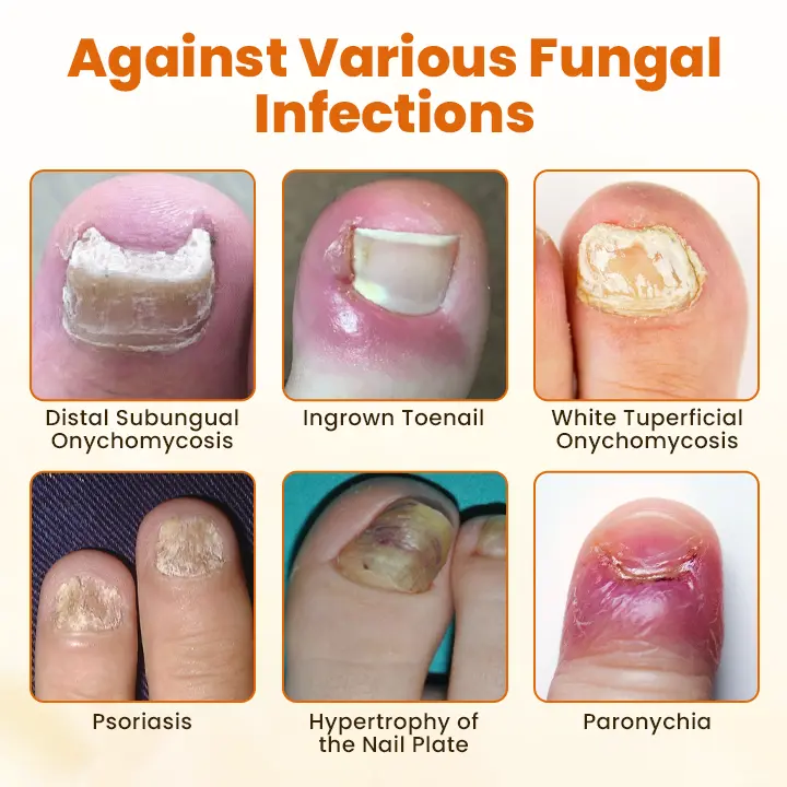 Acezozla® FungiBee Advanced Nail Repair Spray