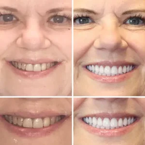 EETTSY™ - Premium Denture