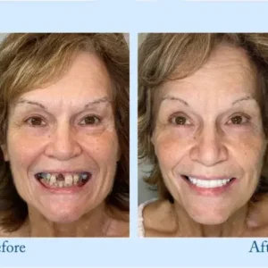 Smileasego™ – Premium-Zahnprothese