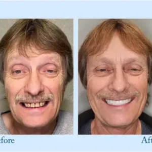 Smileasego™ – Premium-Zahnprothese