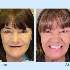 Smileasego™ – Premium-Zahnprothese