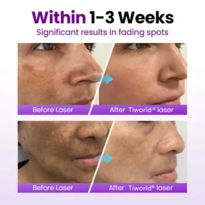 Tiworld® SpotErase Probiotic Shield Serum