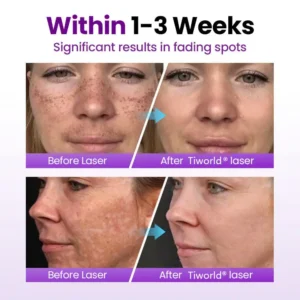 Tiworld® SpotErase Probiotic Shield Serum