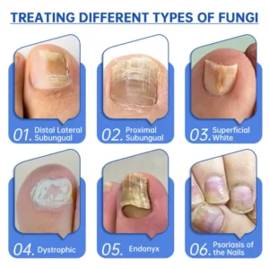 Virexo™ PureNail Fungus Laser Device