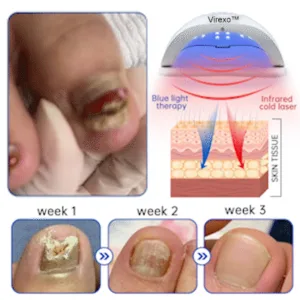 Virexo™ PureNail Fungus Laser Device