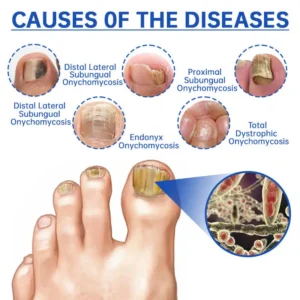Virexo™ PureNail Fungus Laser Device