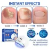 Virexo™ PureNail Fungus Laser Device