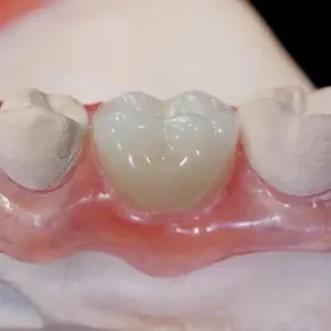 Yagoo® - Premium Denture