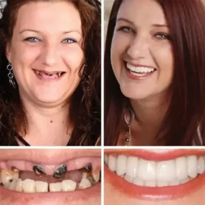 Best 2026 Custom-Fit Full Dentures | Secure Suction Fit