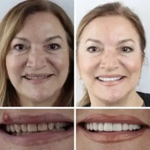 🦷Custom-Fit Dentures | Smile with Confidence