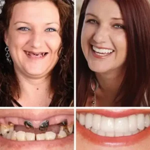 🏆Ends Today: 50% OFF! 🏆2026 Bestselling Product🦷 Fit for a Fresh Smile, Say Goodbye to Wearing Discomfort!