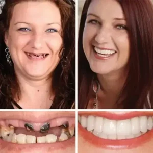 FOMONEST™ Full Denture with Strong Suctiond Custom-Fit Full Functional Dentures🦷