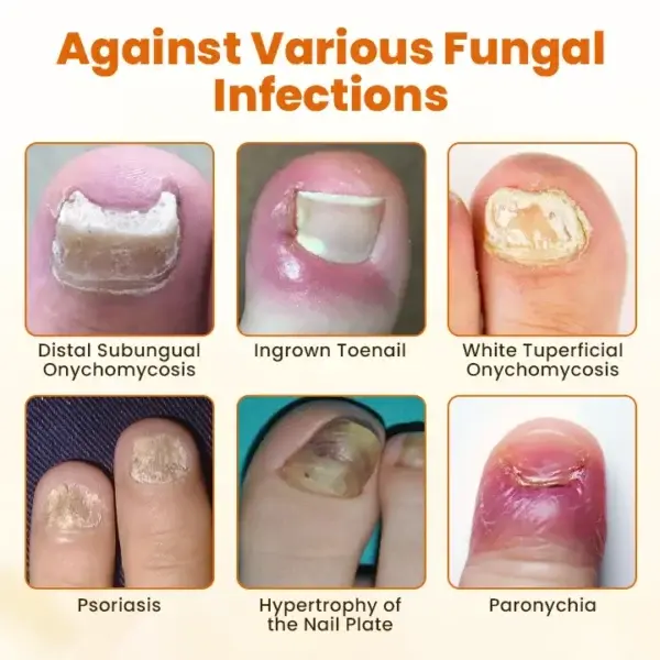 CVREOZ® FungiFix Bee Venom Nail Spray