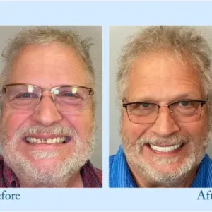 DIYSTAR™ Custom-Fit Functional Dentures