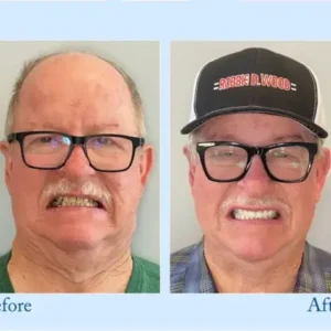 DIYSTAR™ Custom-Fit Functional Dentures
