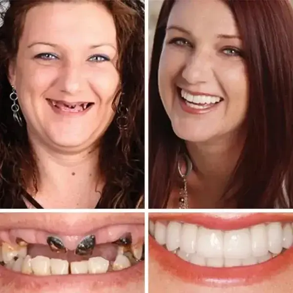 Heaceitr™ Medical Full Denture with Strong Suction (2026 Comfort Fit)