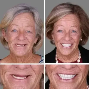 Heaceitr® Premium Full Denture Set