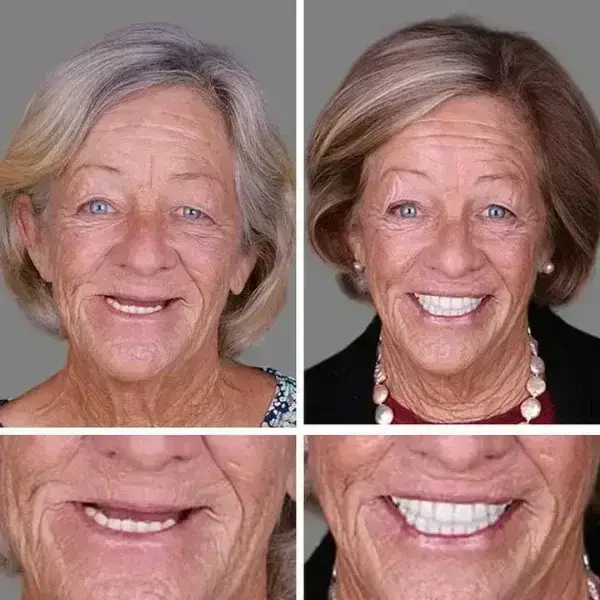 Heaceitr® Premium Full Denture Set