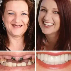 Heaceitr® Premium Full Denture Set