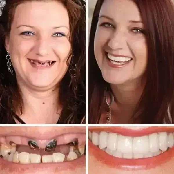 Heaceitr® Premium Full Denture Set