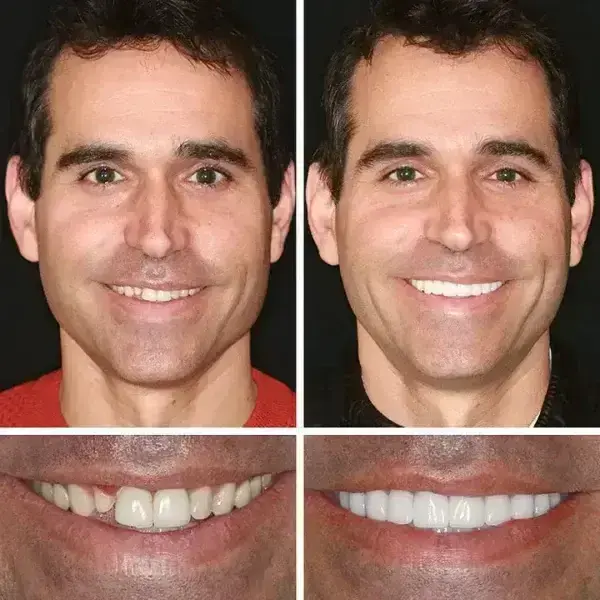 Heaceitr® Premium Full Denture Set