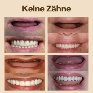 Hidone Premium Gebiss / Zahnprothese