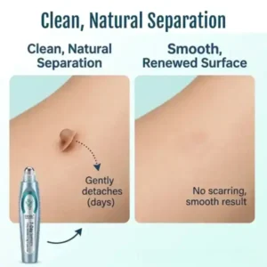 Timilk® SpotlessPro Advanced Skin Care Pen