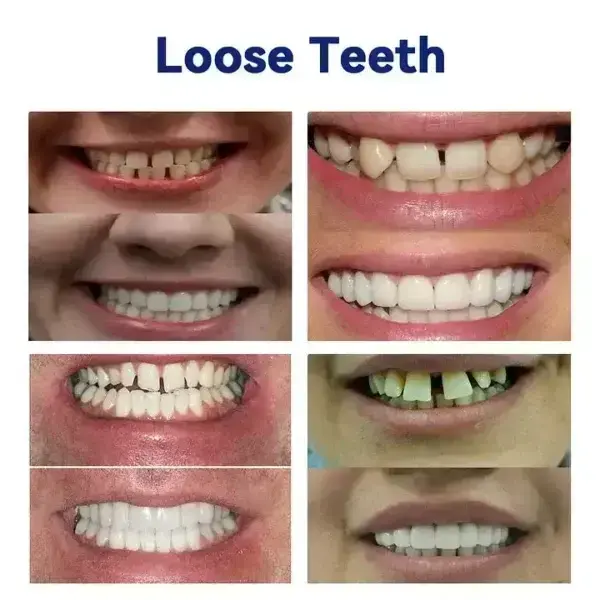 Vaxflite Full Denture Set (Top & Bottom) – Custom Fit Oral Prosthetic