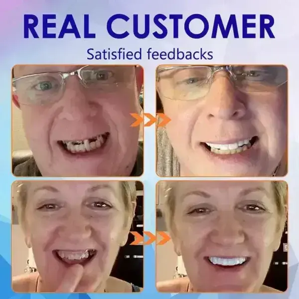 Vaxflite Full Denture Set (Top & Bottom) – Custom Fit Oral Prosthetic