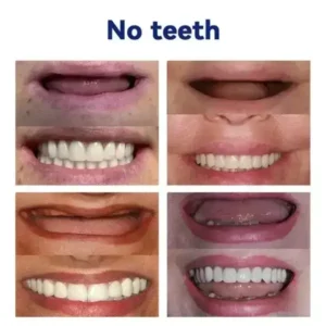 Vaxflite Full Denture Set (Top & Bottom) – Custom Fit Oral Prosthetic