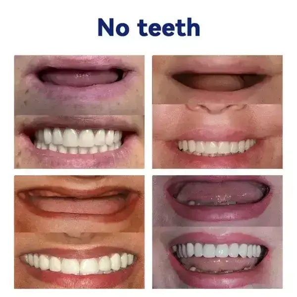 Vaxflite Full Denture Set (Top & Bottom) – Custom Fit Oral Prosthetic
